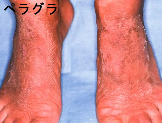 ペラグラ 足 ペラグラ 足