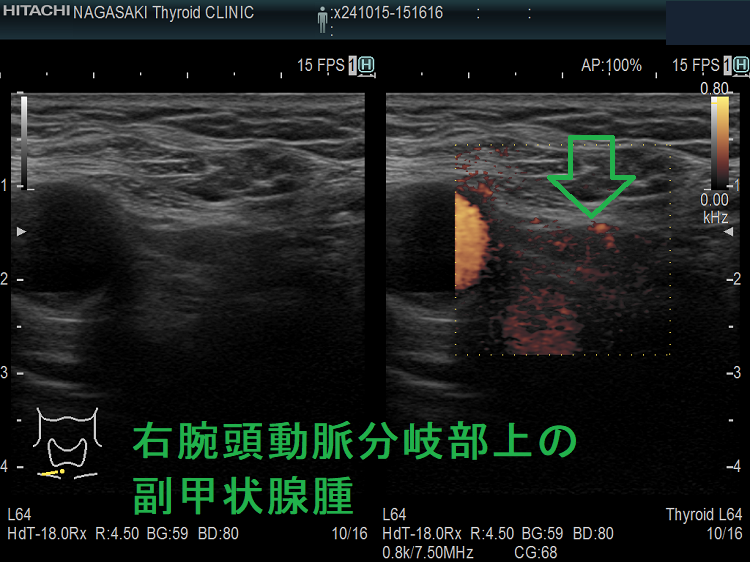 右腕頭動脈分岐部上の副甲状腺腫 ドプラーモード 2 右腕頭動脈分岐部上の副甲状腺腫 ドプラーモード 2