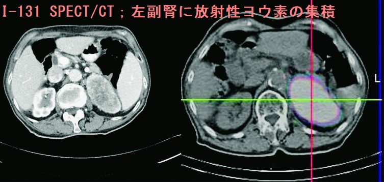 甲状腺乳頭癌の副腎転移 I-131 SPECT/CT 甲状腺乳頭癌の副腎転移 I-131 SPECT/CT