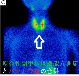 原発性副甲状腺機能亢進症とバセドウ病の合併 原発性副甲状腺機能亢進症とバセドウ病の合併