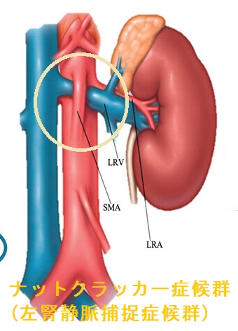 ナットクラッカー症候群(左腎静脈捕捉症候群) ナットクラッカー症候群(左腎静脈捕捉症候群)