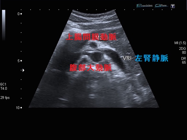 ナットクラッカー症候群(左腎静脈捕捉症候群) 超音波(エコー)画像 ナットクラッカー症候群(左腎静脈捕捉症候群) 超音波(エコー)画像