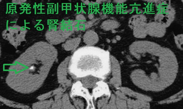 原発性副甲状腺機能亢進症による腎結石 CT画像 原発性副甲状腺機能亢進症による腎結石 CT画像