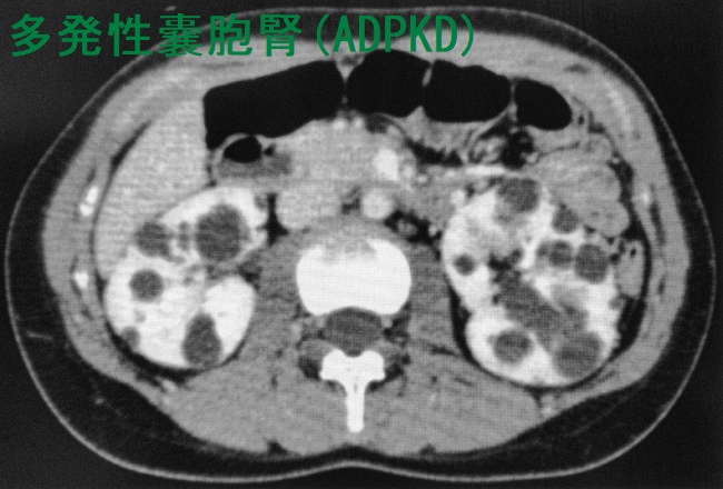 多発性嚢胞腎(ADPKD) 造影CT画像 多発性嚢胞腎(ADPKD) 造影CT画像