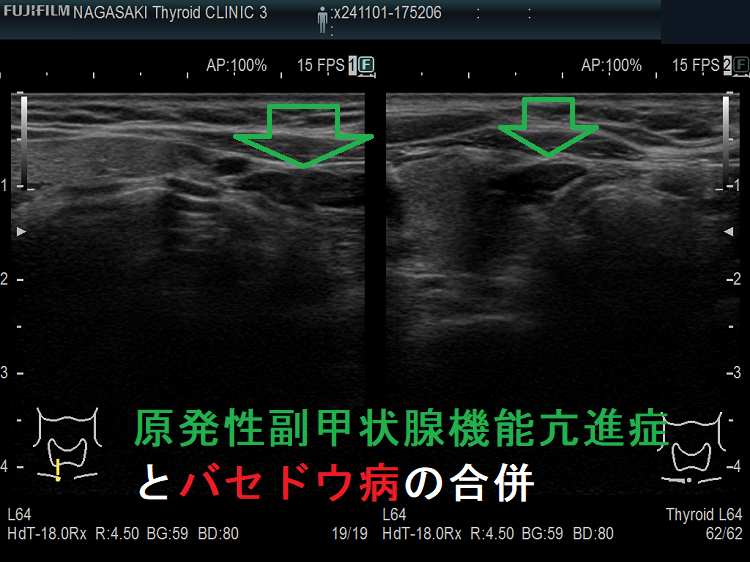 原発性副甲状腺機能亢進症(副甲状腺腺腫)とバセドウ病の合併 原発性副甲状腺機能亢進症(副甲状腺腺腫)とバセドウ病の合併