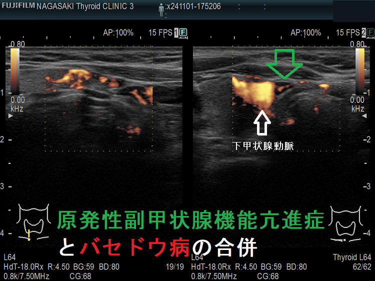 原発性副甲状腺機能亢進症(副甲状腺腺腫)とバセドウ病の合併 ドプラーモード 原発性副甲状腺機能亢進症(副甲状腺腺腫)とバセドウ病の合併 ドプラーモード