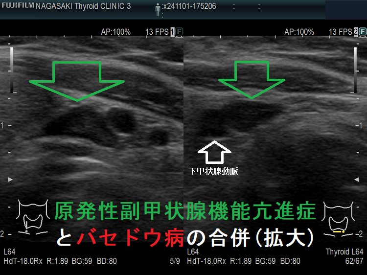 高カルシウム血症は副甲状腺機能亢進症[橋本病 バセドウ病 高カルシウム血症は副甲状腺機能亢進症[橋本病 バセドウ病
