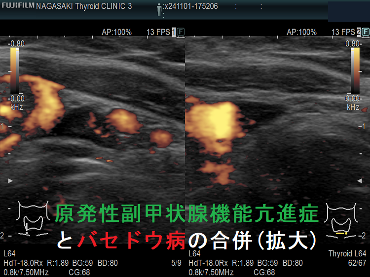 原発性副甲状腺機能亢進症(副甲状腺腺腫)とバセドウ病の合併 (拡大) ドプラーモード 原発性副甲状腺機能亢進症(副甲状腺腺腫)とバセドウ病の合併 (拡大) ドプラーモード