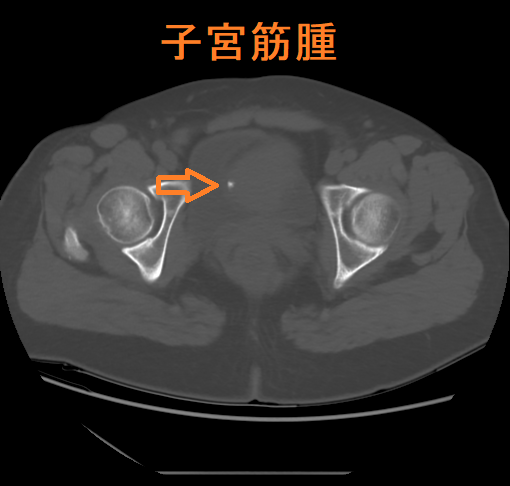 子宮筋腫 単純CT画像 子宮筋腫 単純CT画像