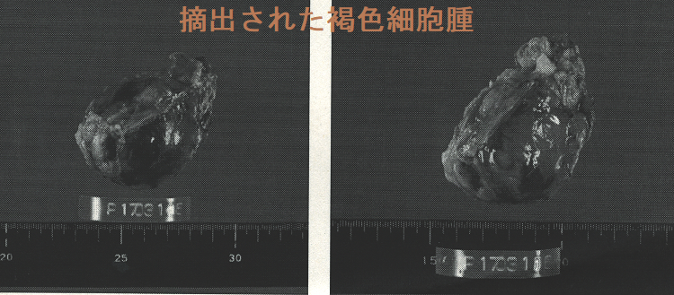 摘出された褐色細胞腫 摘出された褐色細胞腫