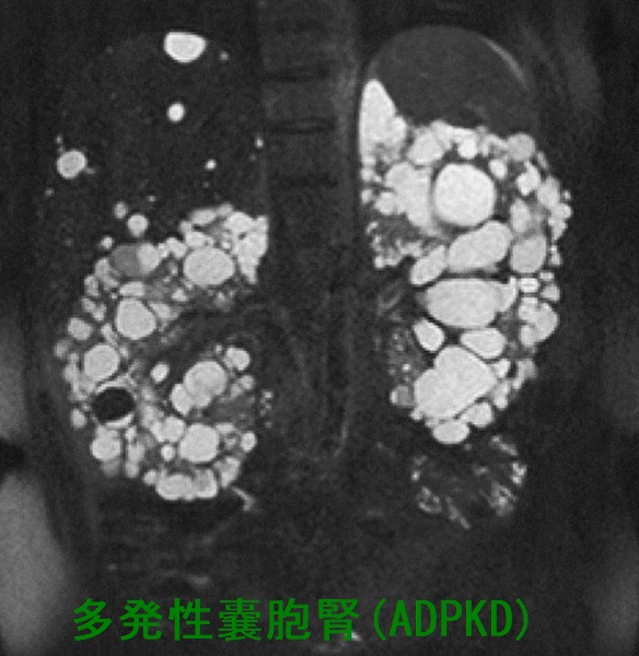 多発性嚢胞腎(ADPKD) MRI脂肪抑制T2強調冠状断像 多発性嚢胞腎(ADPKD) MRI脂肪抑制T2強調冠状断像