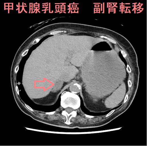 転移性副腎腫瘍・ 副腎皮質癌・ 副腎原発悪性リンパ腫[橋本病