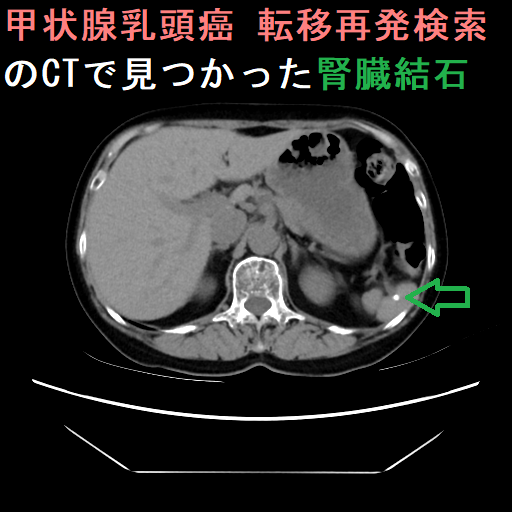 甲状腺乳頭癌 転移再発検索中のCTで見つかった腎臓結石1 甲状腺乳頭癌 転移再発検索中のCTで見つかった腎臓結石1