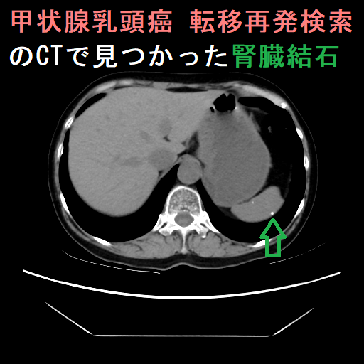 甲状腺乳頭癌 転移再発検索中のCTで見つかった腎臓結石2 甲状腺乳頭癌 転移再発検索中のCTで見つかった腎臓結石2