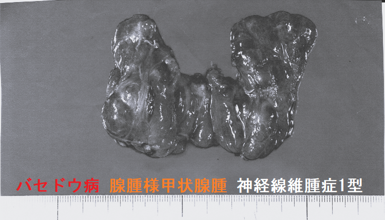 バセドウ病 腺腫様甲状腺腫 神経線維腫症1型 1 バセドウ病 腺腫様甲状腺腫 神経線維腫症1型 1
