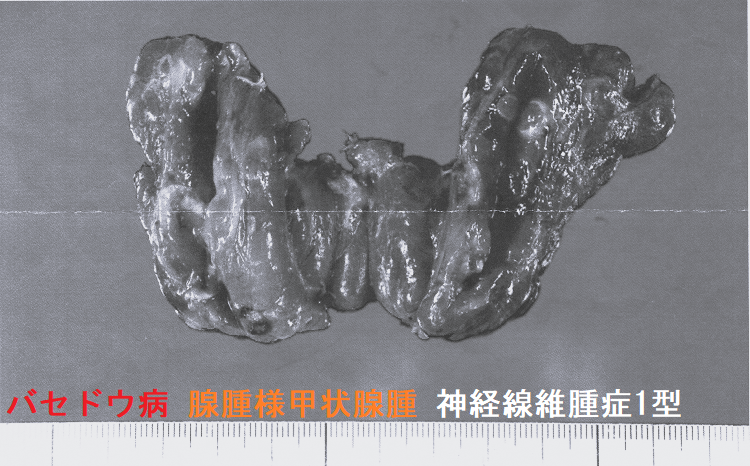 バセドウ病 腺腫様甲状腺腫 神経線維腫症1型 2 バセドウ病 腺腫様甲状腺腫 神経線維腫症1型 2