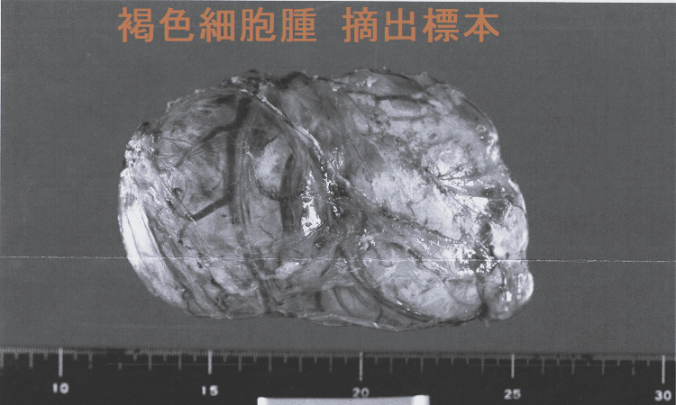 MEN2A 褐色細胞腫 摘出標本 MEN2A 褐色細胞腫 摘出標本