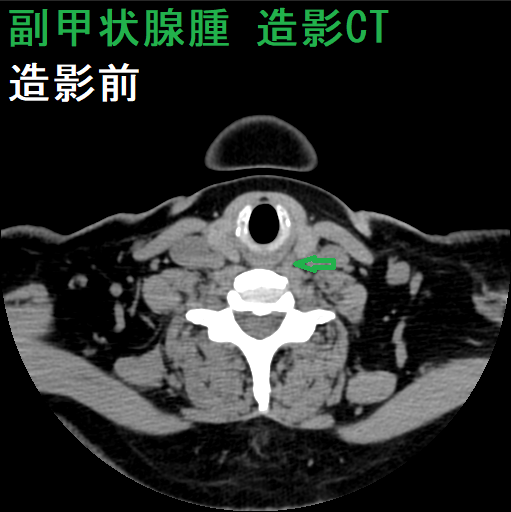 副甲状腺機能亢進症の診断[橋本病 バセドウ病 甲状腺超音波