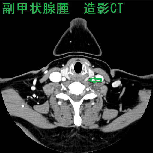 副甲状腺腫 造影CT 造影後(水平断) 副甲状腺腫 造影CT 造影後(水平断)