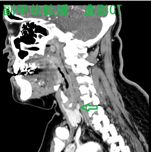 副甲状腺機能亢進症の診断[橋本病 バセドウ病 甲状腺超音波
