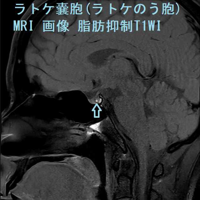 ラトケ嚢胞(ラトケのう胞) MRI 画像 脂肪抑制T1WI ラトケ嚢胞(ラトケのう胞) MRI 画像 脂肪抑制T1WI