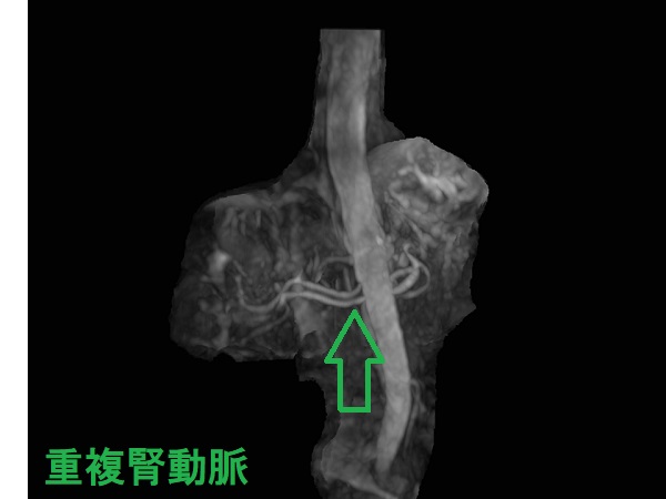 重複腎動脈 MRA画像 重複腎動脈 MRA画像