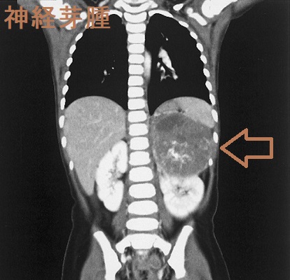 神経芽腫 造影CT画像 神経芽腫 造影CT画像