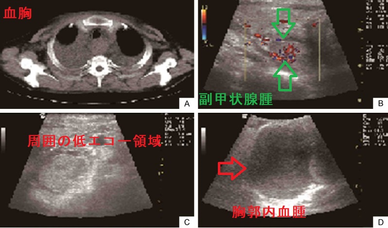 副甲状腺腺腫の自然破裂による出血 副甲状腺腺腫の自然破裂による出血