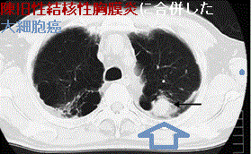陳旧性結核性胸膜炎に合併した大細胞癌 CT画像 陳旧性結核性胸膜炎に合併した大細胞癌 CT画像