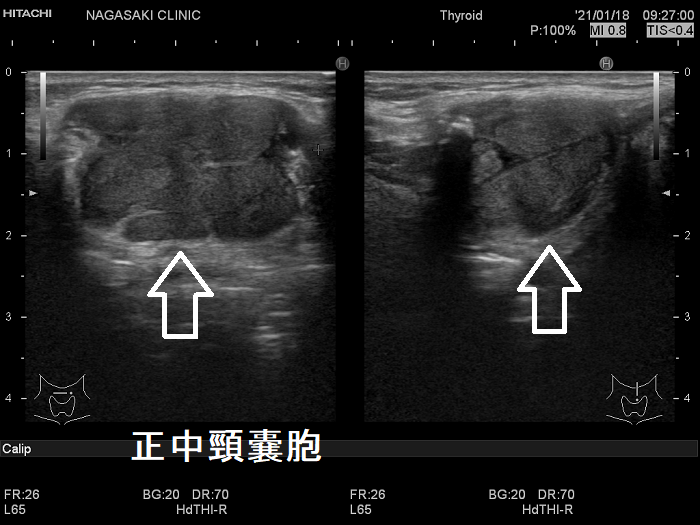 舌根部の正中頸のう胞(甲状舌管嚢胞) 超音波(エコー)画像 舌根部の正中頸のう胞(甲状舌管嚢胞) 超音波(エコー)画像