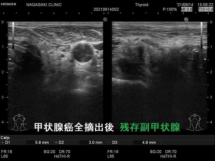 甲状腺癌全摘出後残存副甲状腺 甲状腺癌全摘出後残存副甲状腺