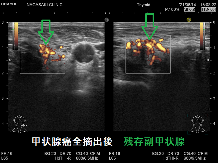 甲状腺癌全摘出後残存副甲状腺 ドプラー 甲状腺癌全摘出後残存副甲状腺 ドプラー