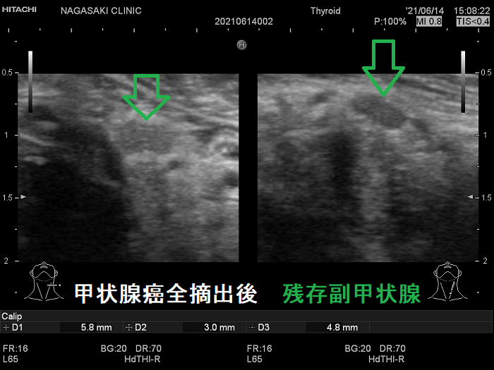 甲状腺癌全摘出後 残存副甲状腺 拡大 甲状腺癌全摘出後 残存副甲状腺 拡大