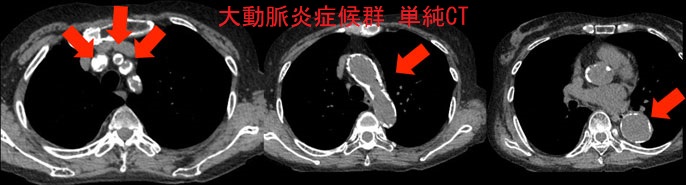 大動脈炎症候群 単純CT 大動脈炎症候群 単純CT