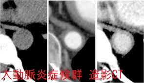 大動脈炎症候群 造影CT 大動脈炎症候群 造影CT