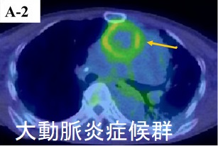 大動脈炎症候群 FDG-PET 大動脈炎症候群 PET-CT