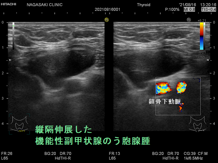 縦隔伸展した機能性副甲状腺のう胞腺腫 縦隔伸展した機能性副甲状腺のう胞腺腫
