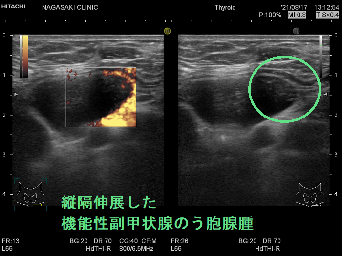 縦隔伸展した機能性副甲状腺のう胞腺腫 縦隔伸展した機能性副甲状腺のう胞腺腫