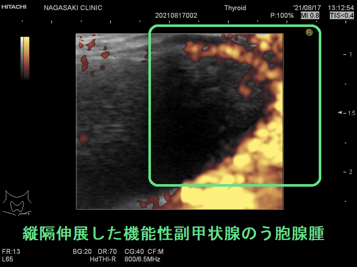 あたかもリンパ節の様な形の副甲状腺腺腫 ドプラー 縦隔伸展した機能性副甲状腺のう胞腺腫4