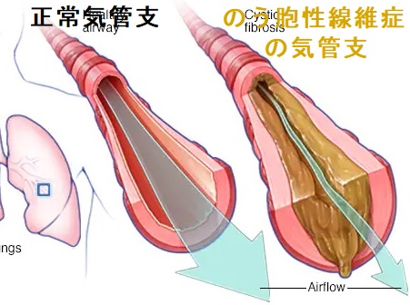のう胞性線維症の気管支 のう胞性線維症の気管支