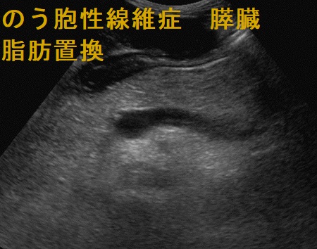 のう胞性線維症 膵臓 脂肪置換 エコー所見 のう胞性線維症 膵臓 脂肪置換 エコー所見