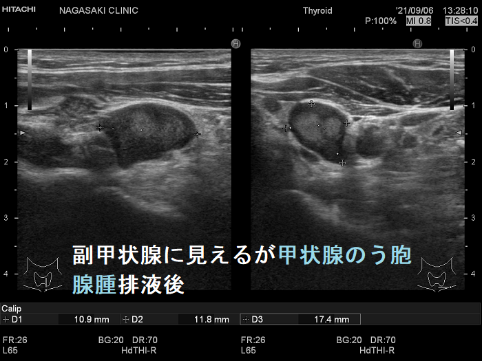 副甲状腺に見えるが甲状腺のう胞腺腫排液後 超音波(エコー)画像 副甲状腺に見えるが甲状腺のう胞腺腫排液後 超音波(エコー)画像