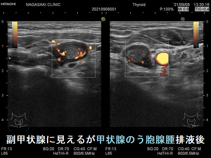 副甲状腺に見えるが甲状腺のう胞腺腫排液後 超音波(エコー)画像 ドプラー 副甲状腺に見えるが甲状腺のう胞腺腫排液後 超音波(エコー)画像 ドプラー