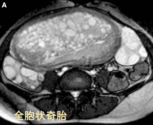全胞状奇胎 MRI画像 全胞状奇胎 MRI画像