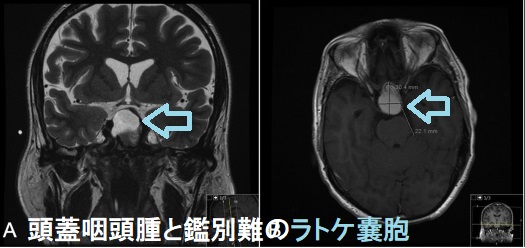 頭蓋咽頭腫と鑑別難のラトケ嚢胞 頭蓋咽頭腫と鑑別難のラトケ嚢胞