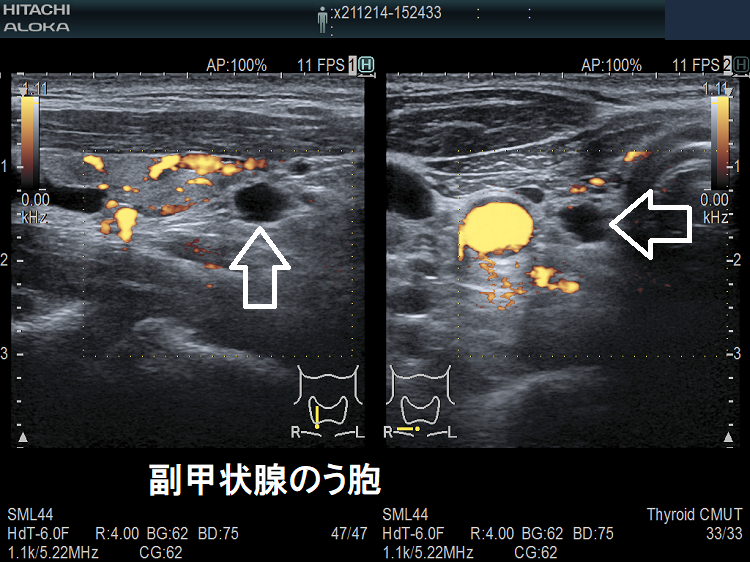 小型の副甲状腺のう胞 小型の副甲状腺のう胞