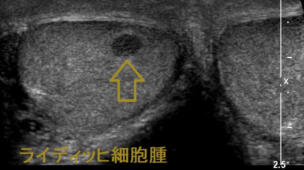 ライディッヒ細胞腫 超音波(エコー)画像 ライディッヒ細胞腫 超音波(エコー)画像