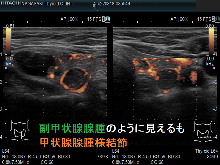 副甲状腺腺腫のように見えるも甲状腺腺腫様結節 超音波(エコー)画像 ドプラー 副甲状腺腺腫のように見えるも甲状腺腺腫様結節 超音波(エコー)画像 ドプラー
