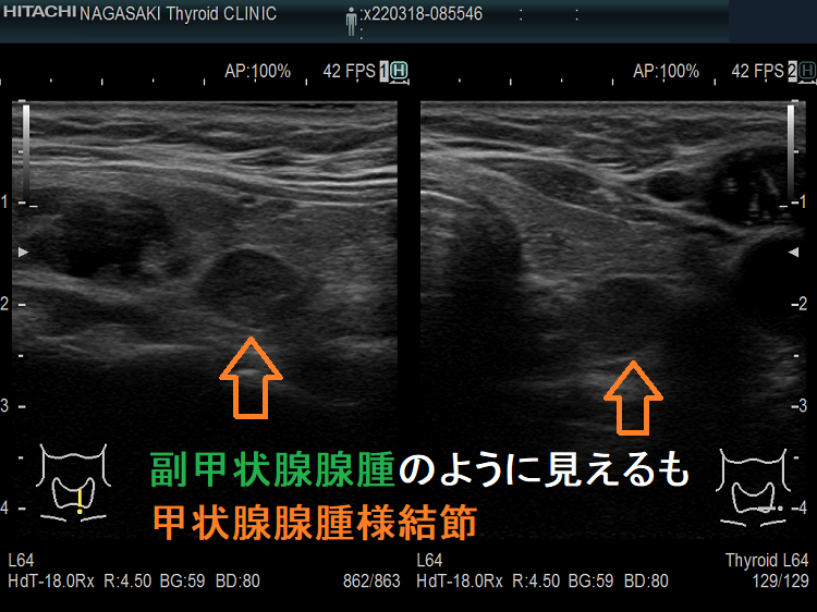 副甲状腺腺腫のように見えるも甲状腺腺腫様結節 超音波(エコー)画像 副甲状腺腺腫のように見えるも甲状腺腺腫様結節 超音波(エコー)画像