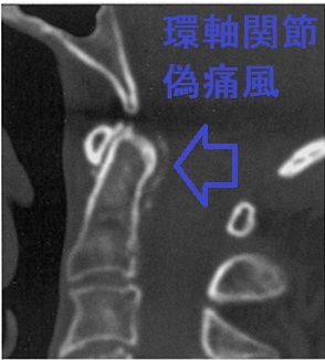 環軸関節偽痛風 CT画像(矢状断) 環軸関節偽痛風 CT画像(矢状断)